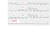 Tachycardie ventriculaire à QRS larges