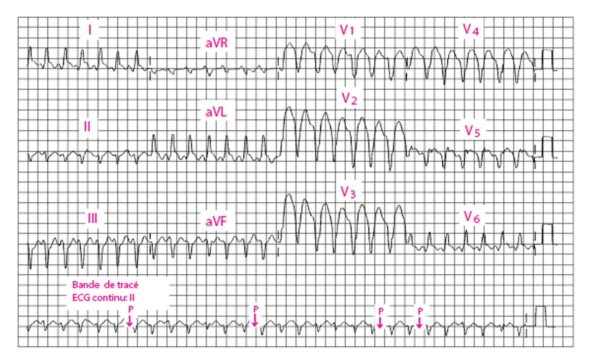 Tachycardie ventriculaire à QRS larges