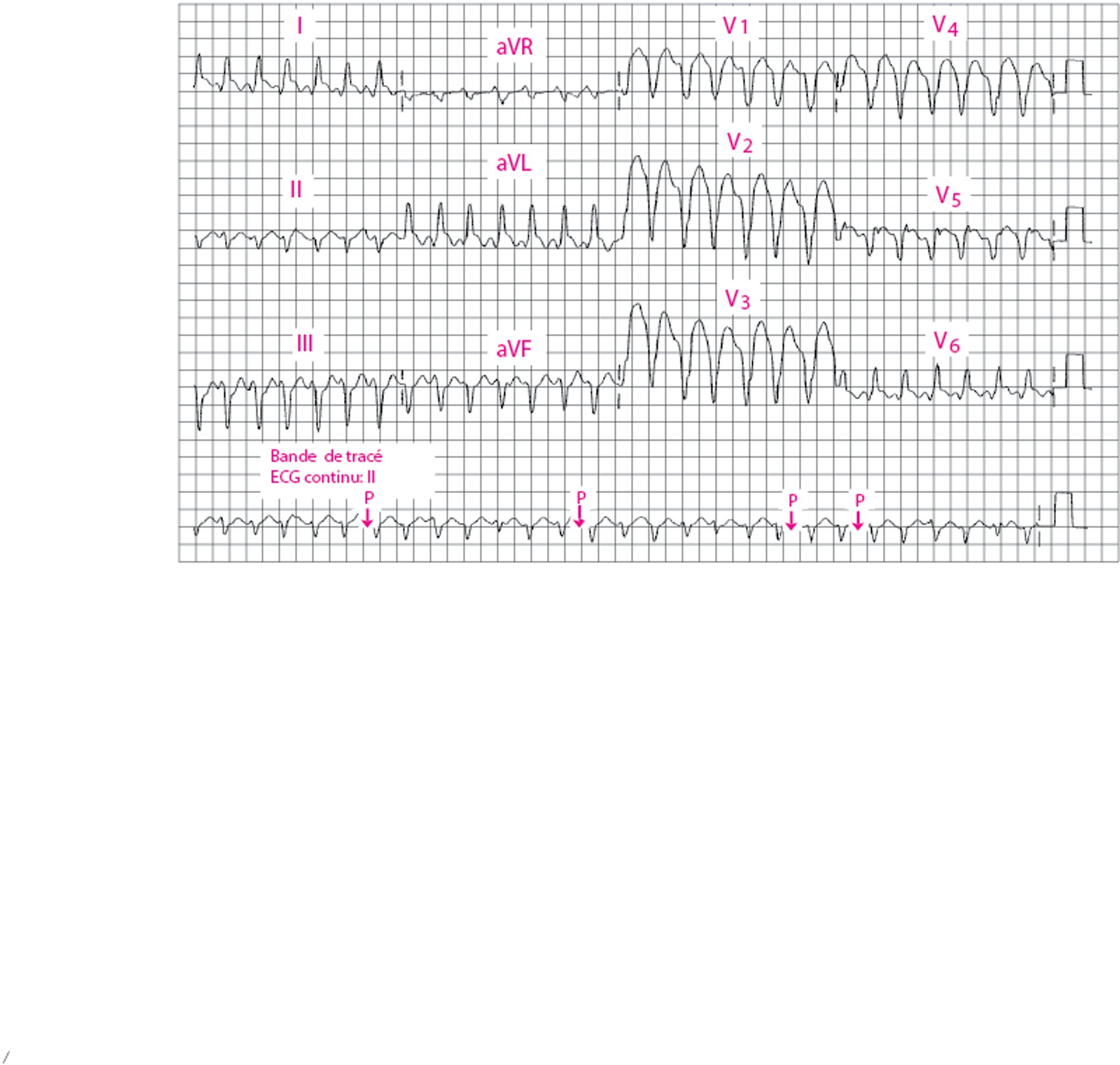 Tachycardie ventriculaire à QRS larges