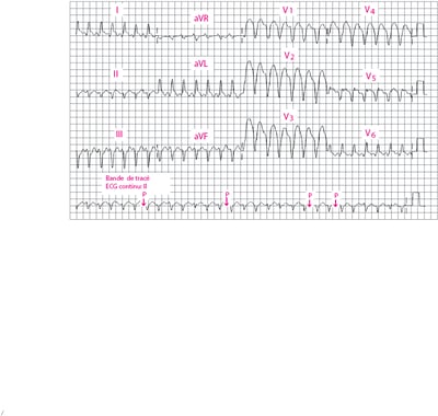 Tachycardie ventriculaire à QRS larges