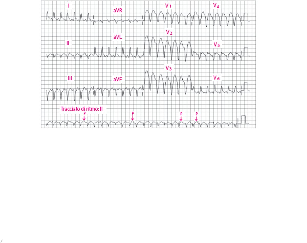 Tachicardia ventricolare a QRS largo