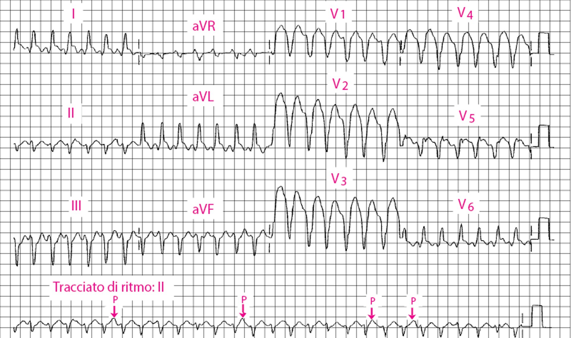 Tachicardia ventricolare a QRS largo