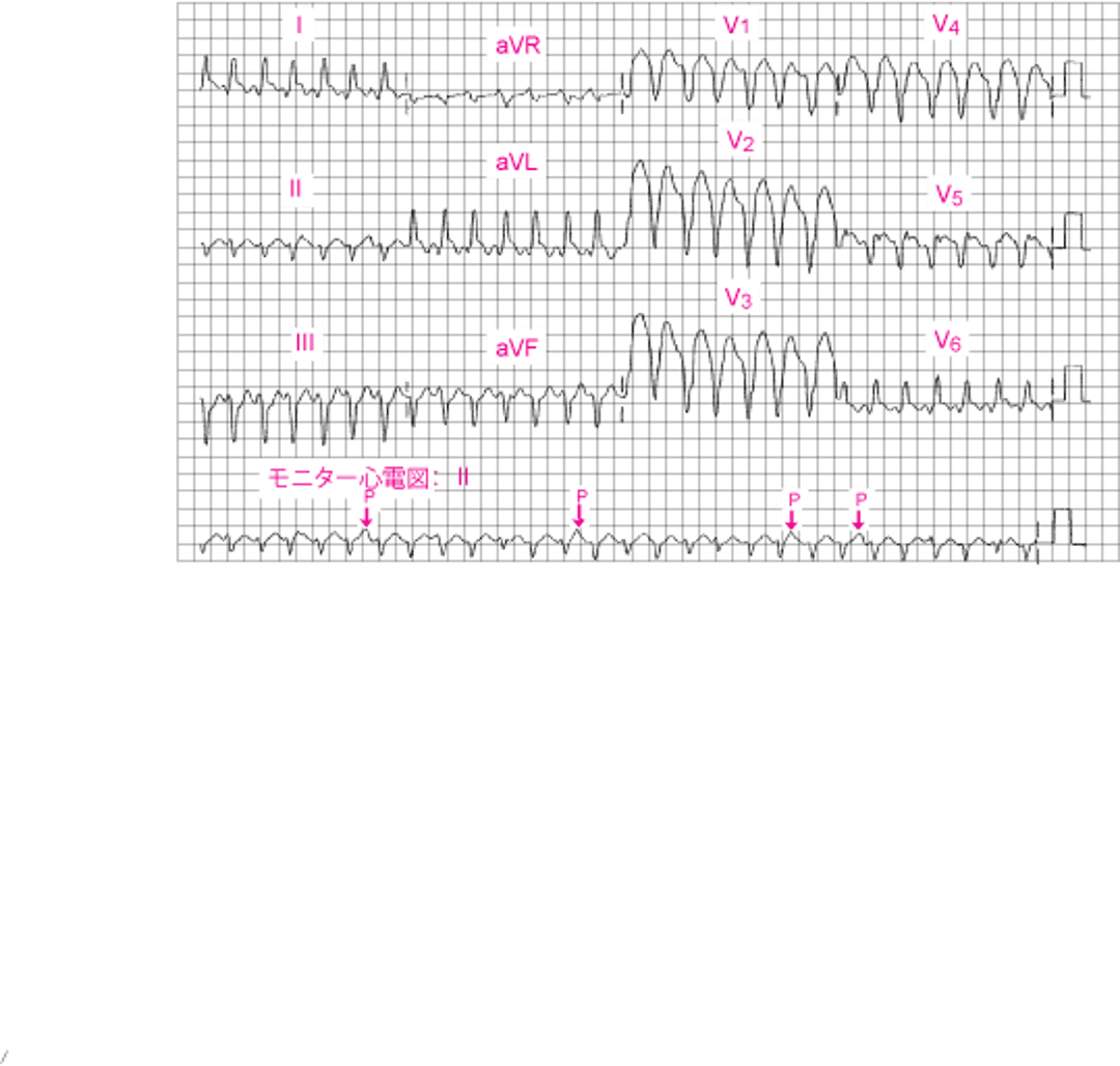 QRS幅の広い心室頻拍