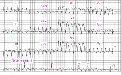 Желудочковая тахикардия с широкими QRS.