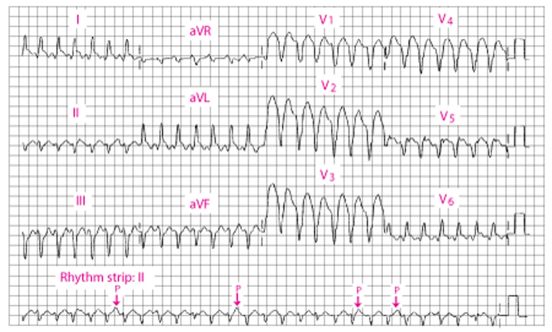 Nhịp nhanh thất có QRS rộng