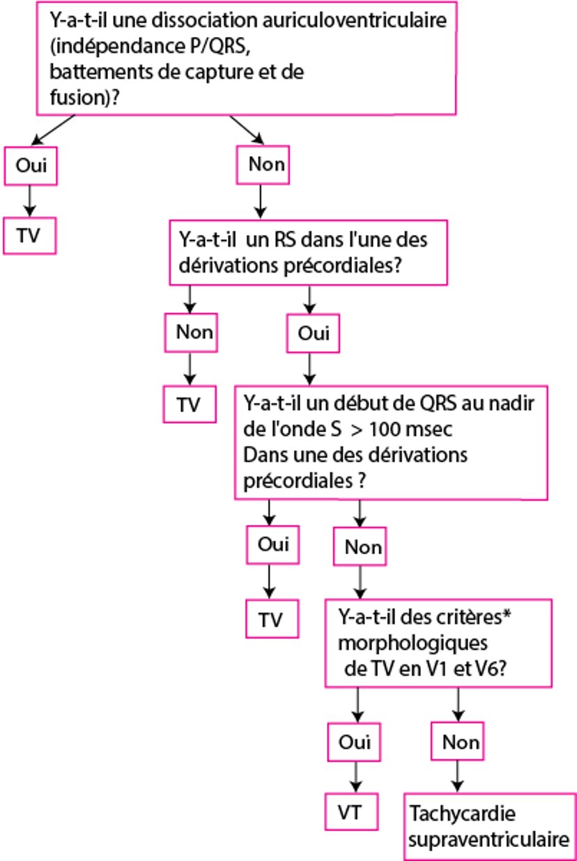 Critères de Brugada modifiés pour la tachycardie ventriculaire