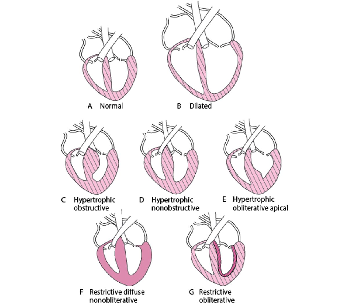 Forms of Cardiomyopathy