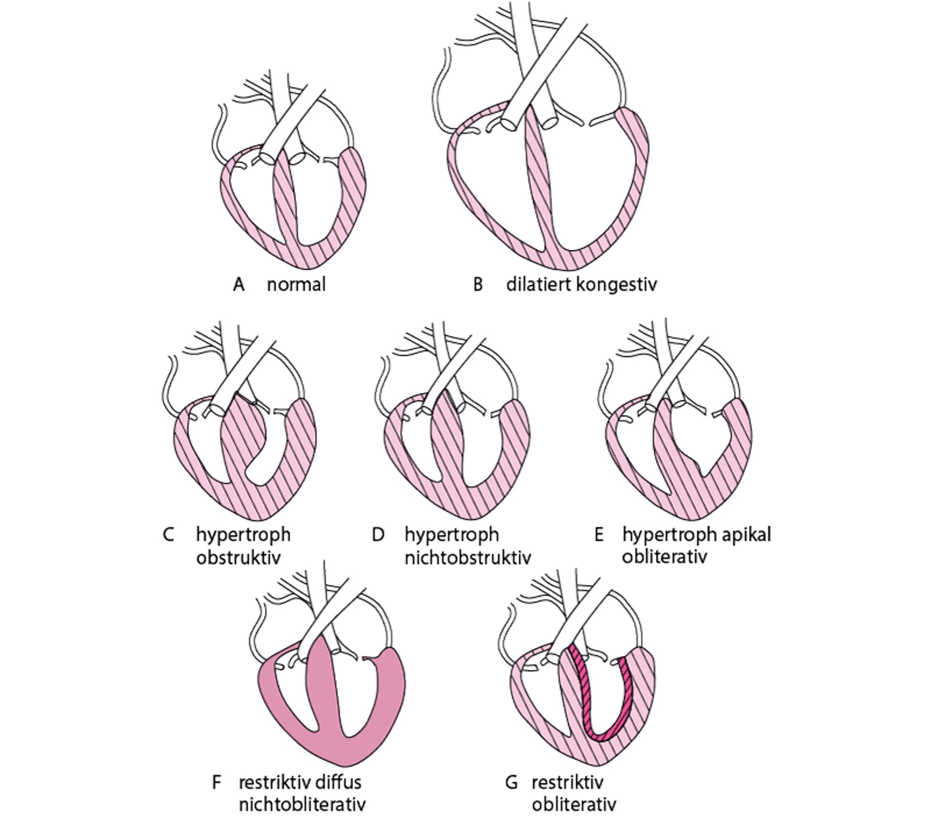 Formen der Kardiomyopathie