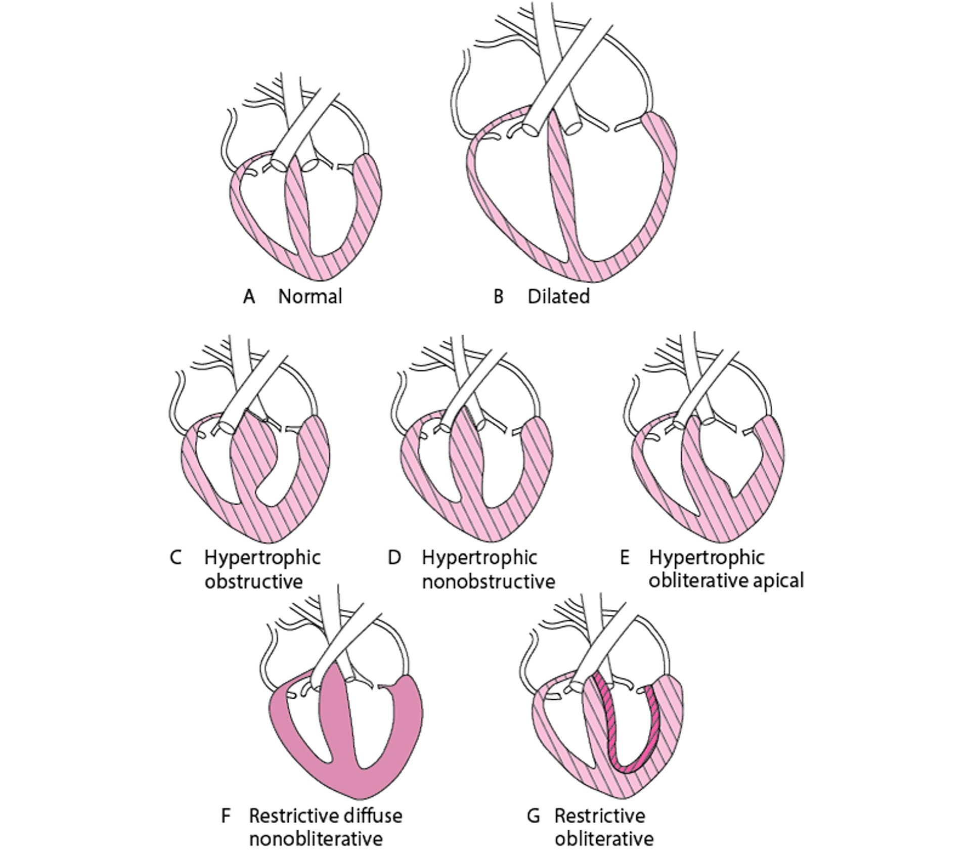 Formas de miocardiopatía