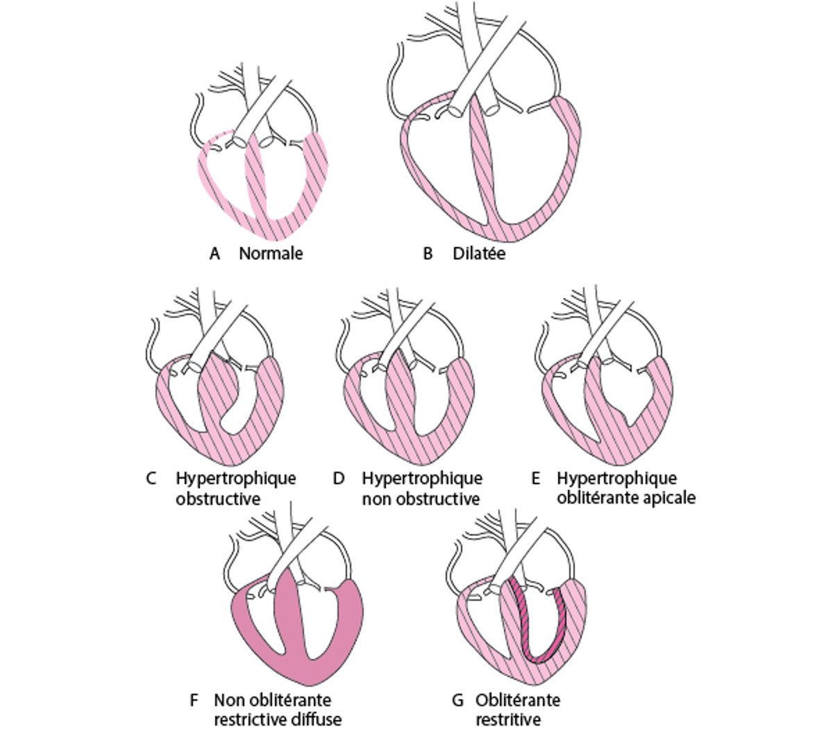 Formes de cardiomyopathie