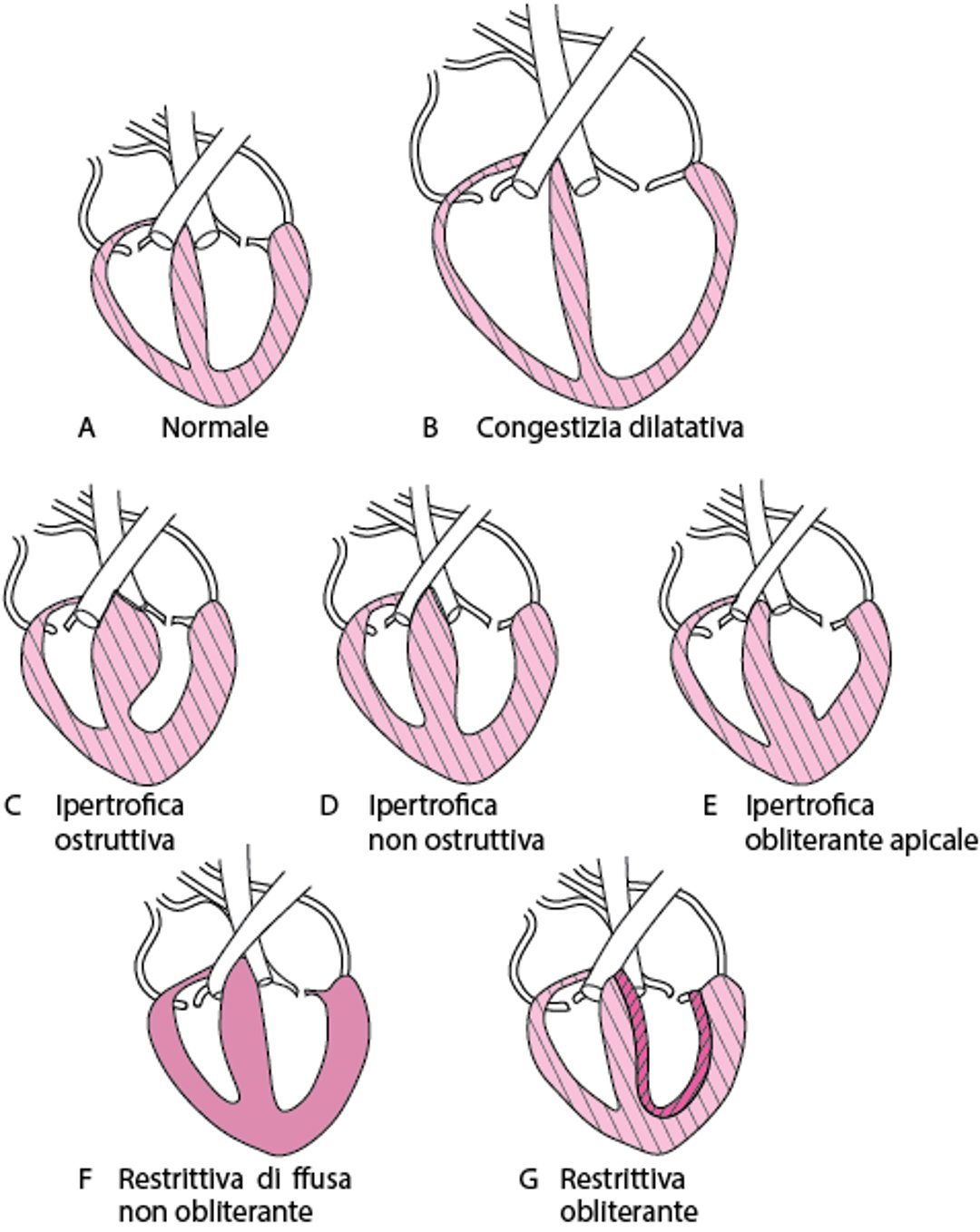 Tipi di cardiomiopatia