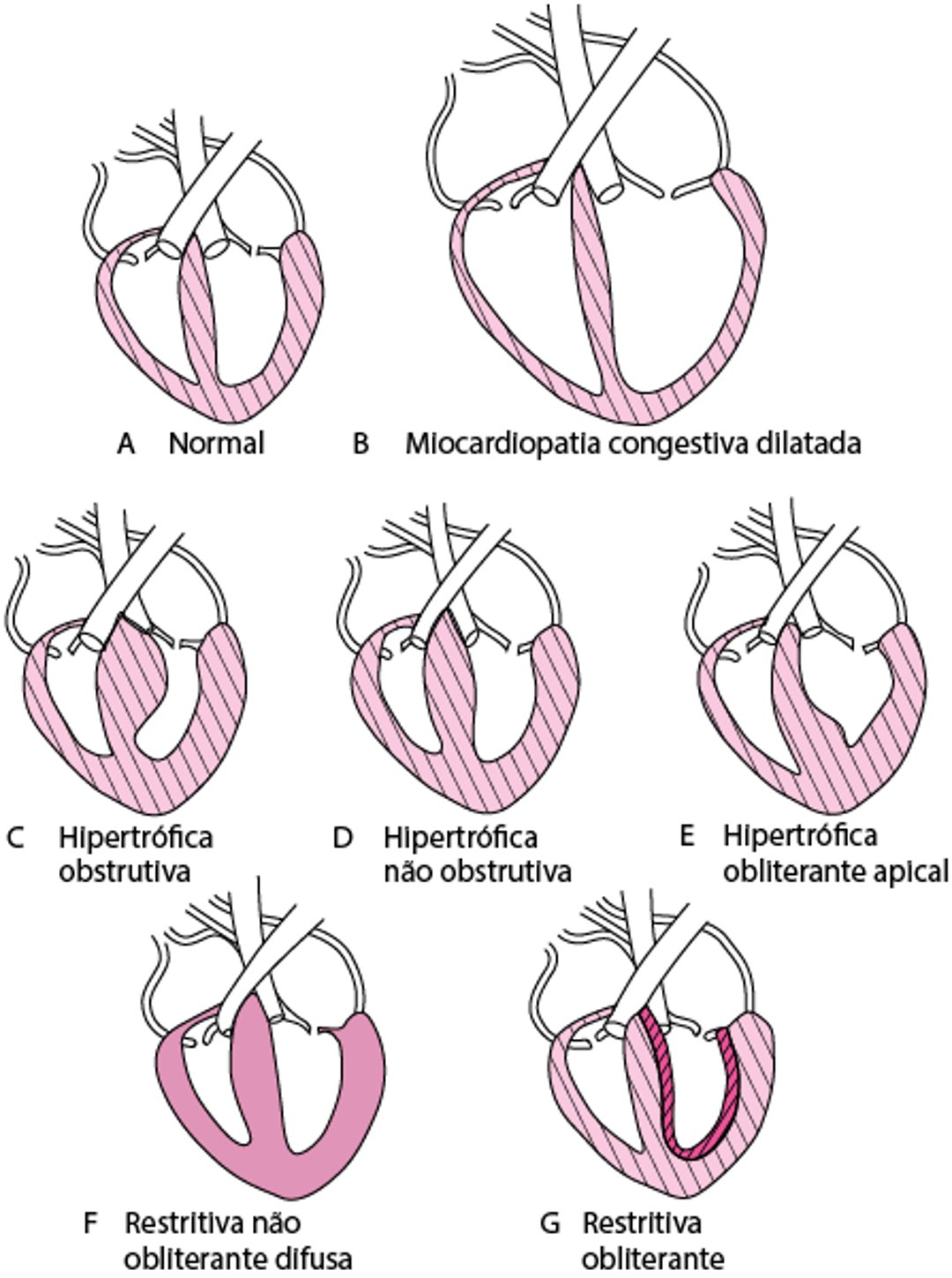 Formas de cardiomiopatia