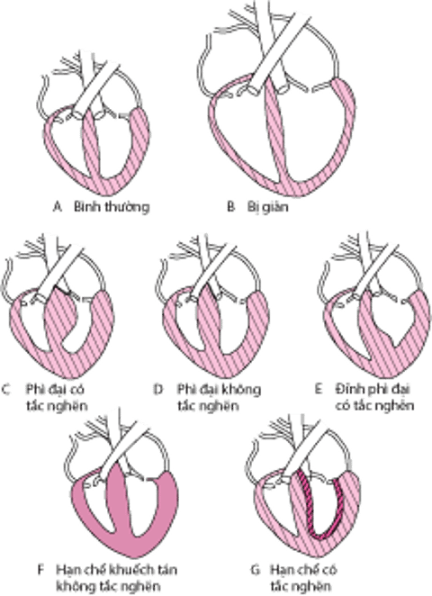 Các dạng bệnh cơ tim