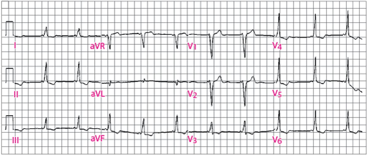 Classic Wolff-Parkinson-White (WPW) Pattern
