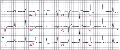 Classic Wolff-Parkinson-White (WPW) Pattern