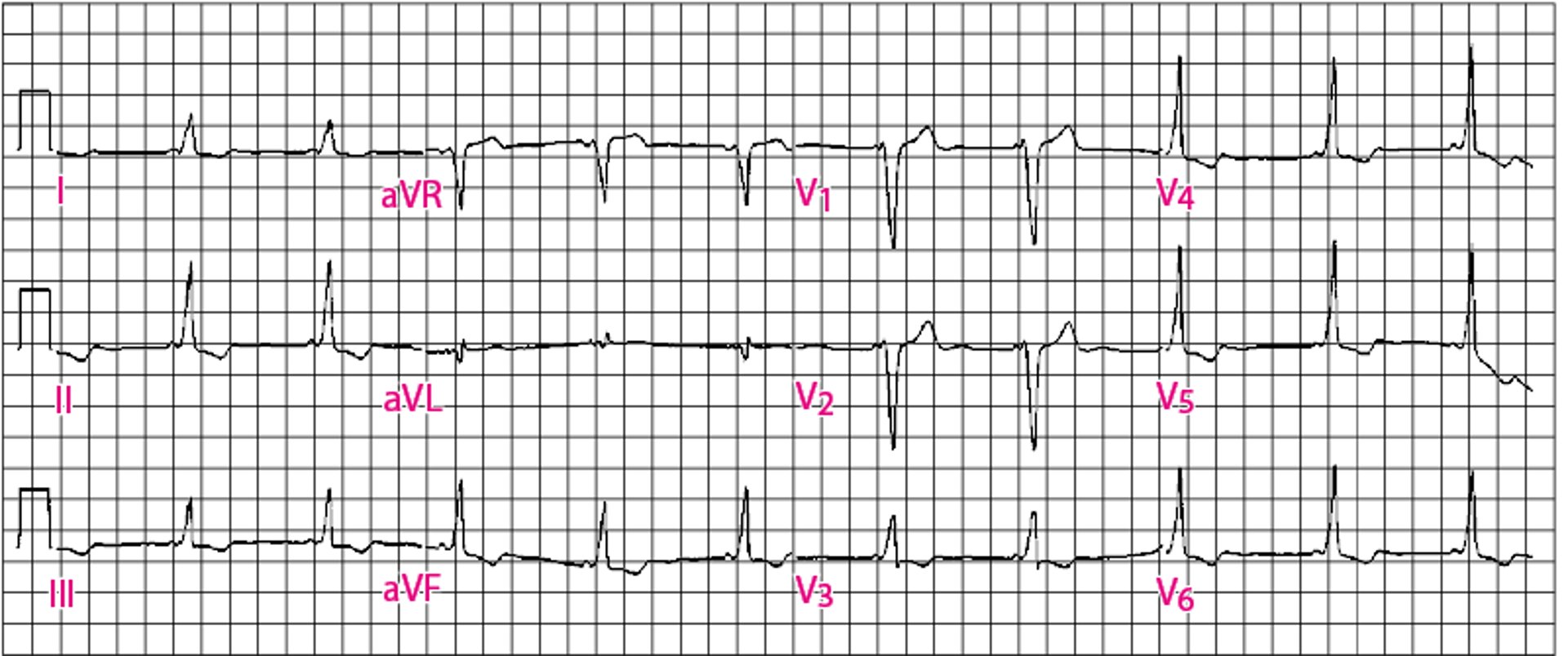 Klassisches Wolff-Parkinson-White (WPW)-Muster