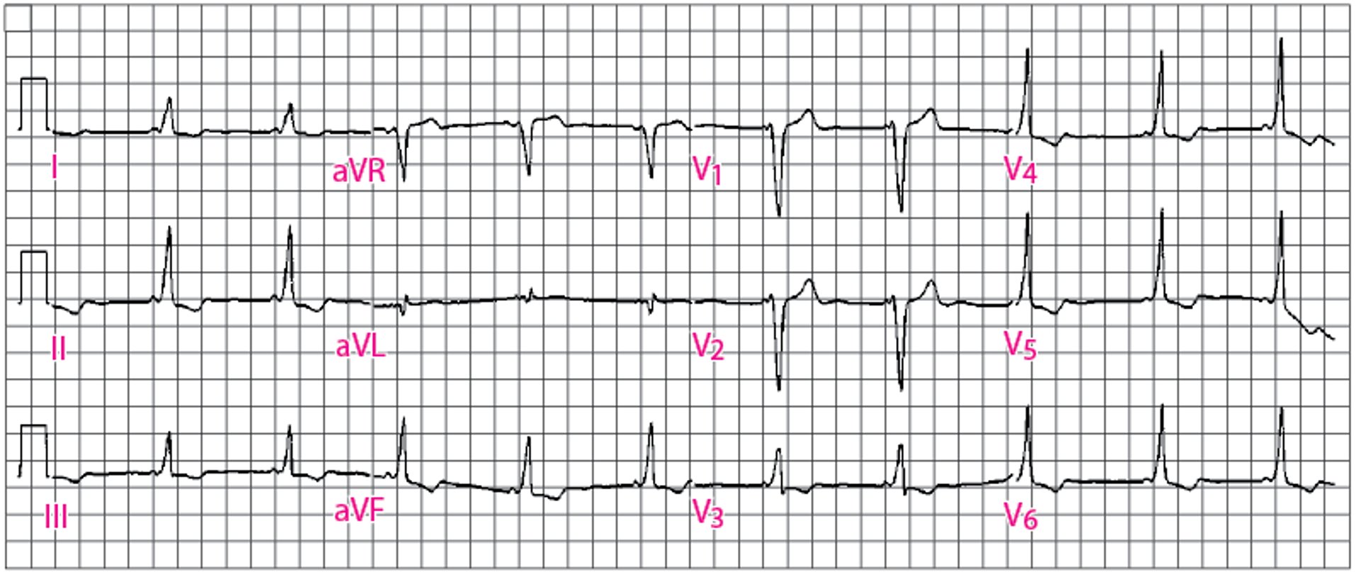 Aspect du syndrome de Wolff-Parkinson-White classique