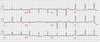 Modello (Pattern) classico della sindrome di Wolff-Parkinson-White