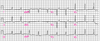 古典的WPW（Wolff-Parkinson-White）症候群