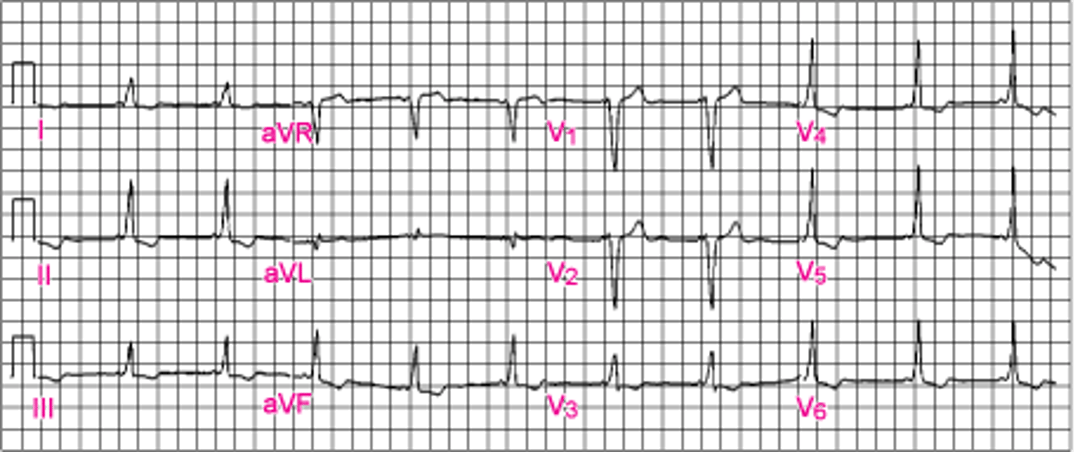 古典的WPW（Wolff-Parkinson-White）症候群