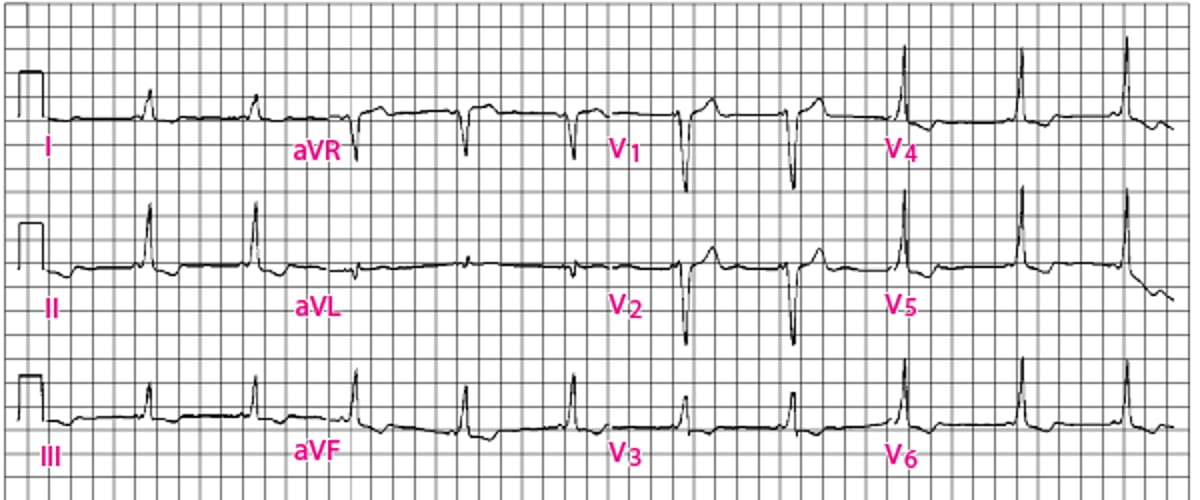 Padrão de Wolff-Parkinson-White clássico