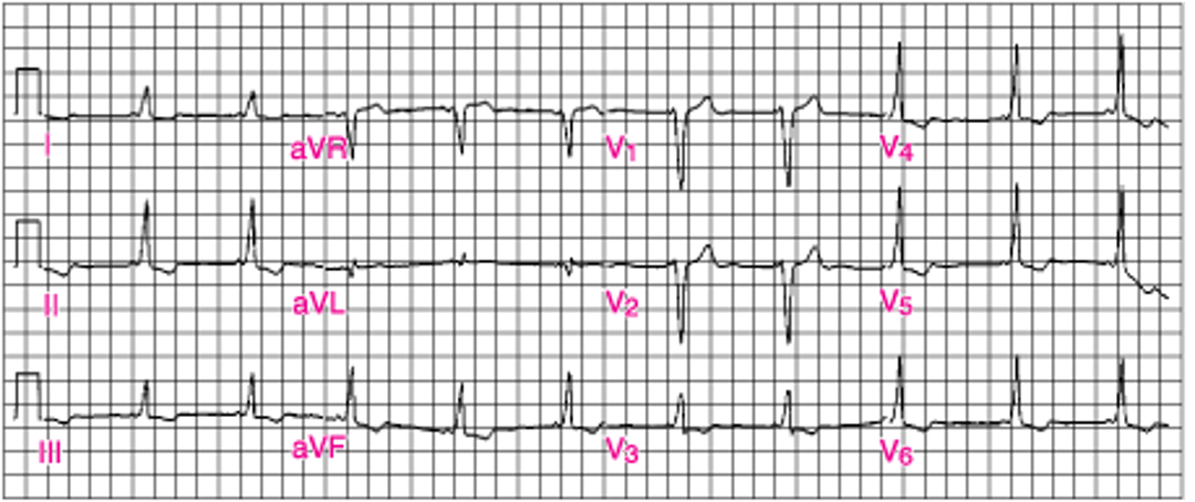 Классическая ЭКГ-картина при синдроме Вольфа-Паркинсона-Уайта (ВПУ)