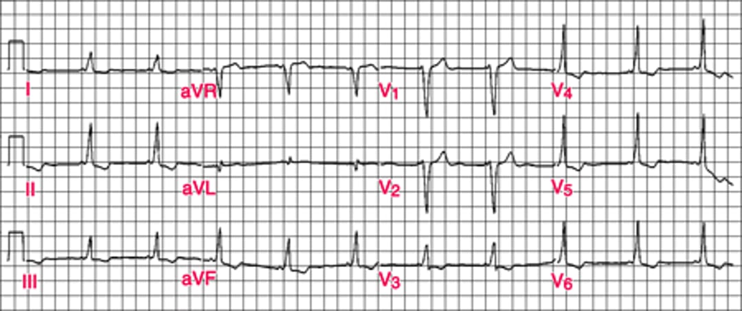 Dạng Wolff-Parkinson-White (WPW) cổ điển