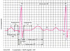 Ondas de electrocardiografía (ECG)