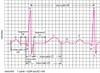Ondes d'électrocardiographie (ECG)