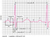 Onde elettrocardiografiche (ECG)