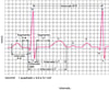 Ondas de eletrocardiografia (ECG)