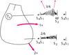 Diagrama de los hallazgos del examen físico en un paciente con estenosis aórtica e insuficiencia mitral