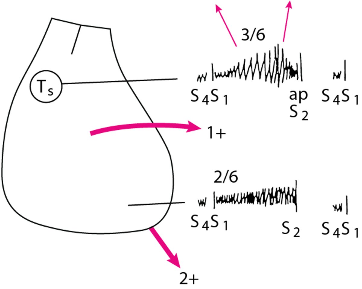 Diagrama de los hallazgos del examen físico en un paciente con estenosis aórtica e insuficiencia mitral