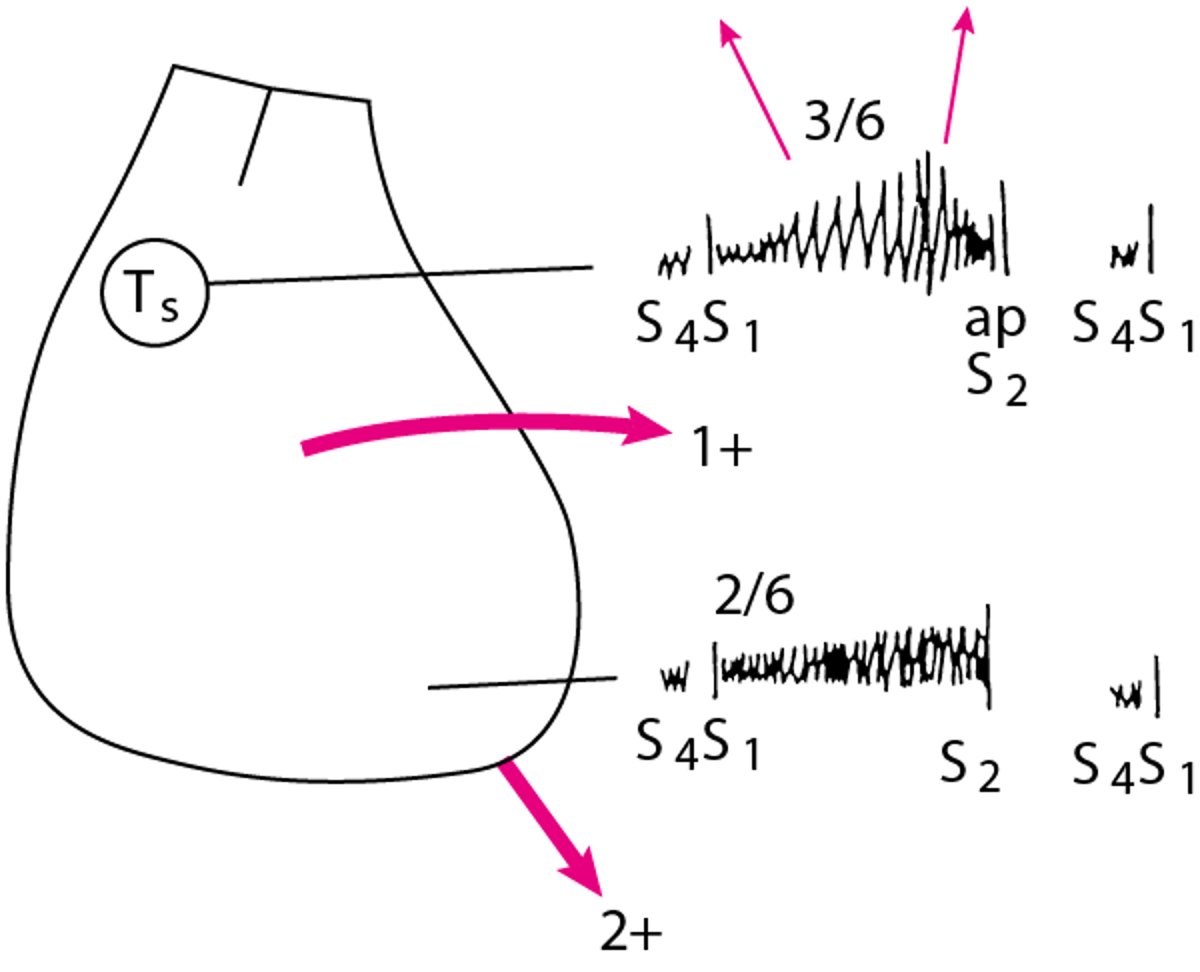 Rappresentazione schematica dei segni obiettivi in un paziente con stenosi aortica e insufficienza mitralica