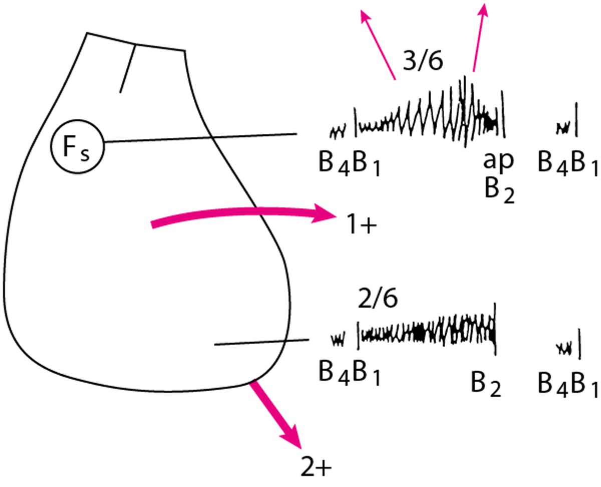 Diagrama de achados físicos em um paciente com estenose aórtica e regurgitação mitral