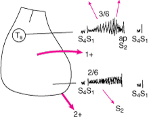 Данные физикального осмотра у пациента с аортальным стенозом и митральной регургитацией