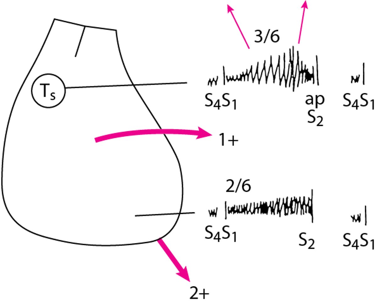 Діаграма змін при фізикальному обстеженні в пацієнта зі стенозом аортального клапану та мітральною регургітацією