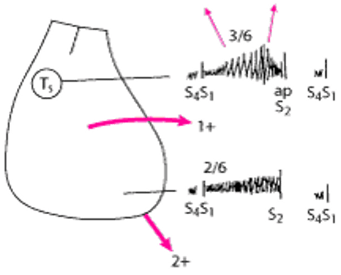 Sơ đồ các dấu hiệu thực thể ở bệnh nhân bị hẹp van động mạch chủ và hở van hai lá