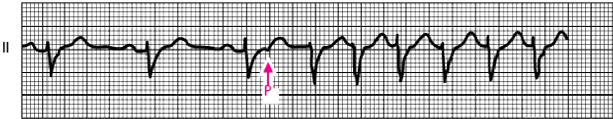Initiation of an Atrioventricular Nodal Reentry Tachycardia