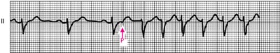 Initiation of an Atrioventricular Nodal Reentry Tachycardia