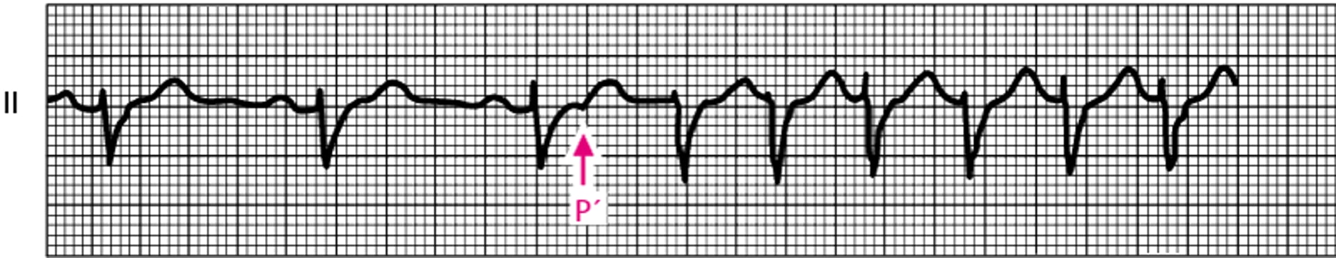 Anbahnung einer AV-Knoten-Reentry-Tachykardie