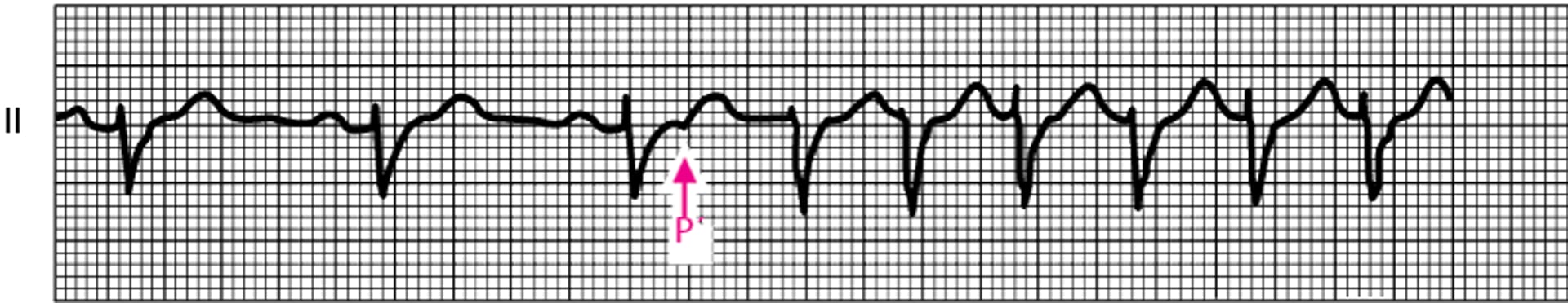 Establecimiento de una taquicardia de reentrada en el nodo auriculoventricular