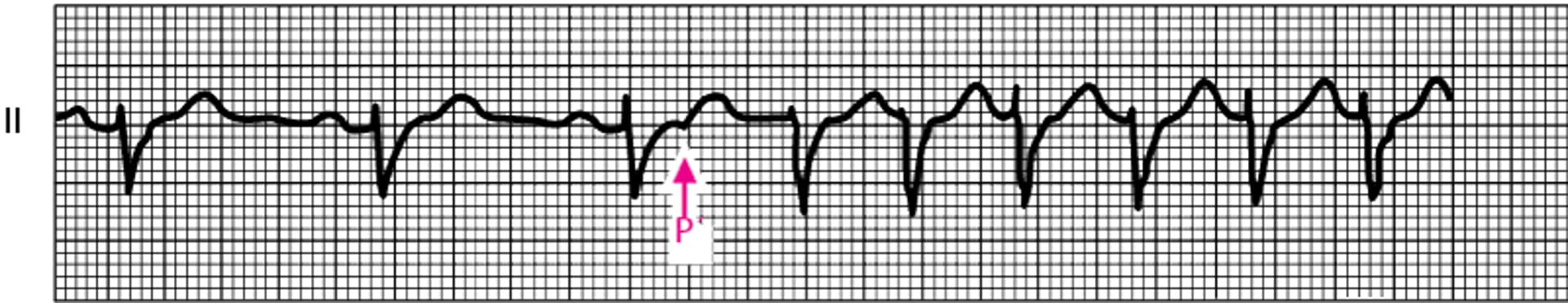 Establecimiento de una taquicardia de reentrada en el nodo auriculoventricular