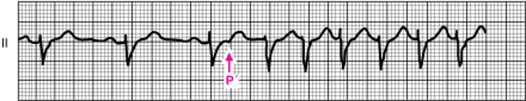 Инициирование АВ узловой реентри тахикардии
