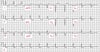 Left Bundle Branch Block