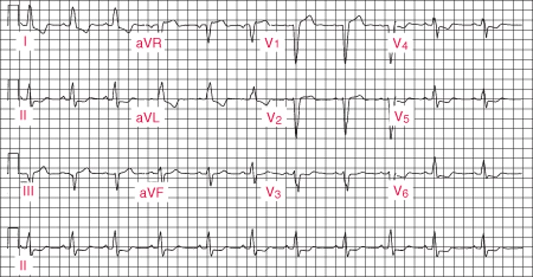 Left Bundle Branch Block