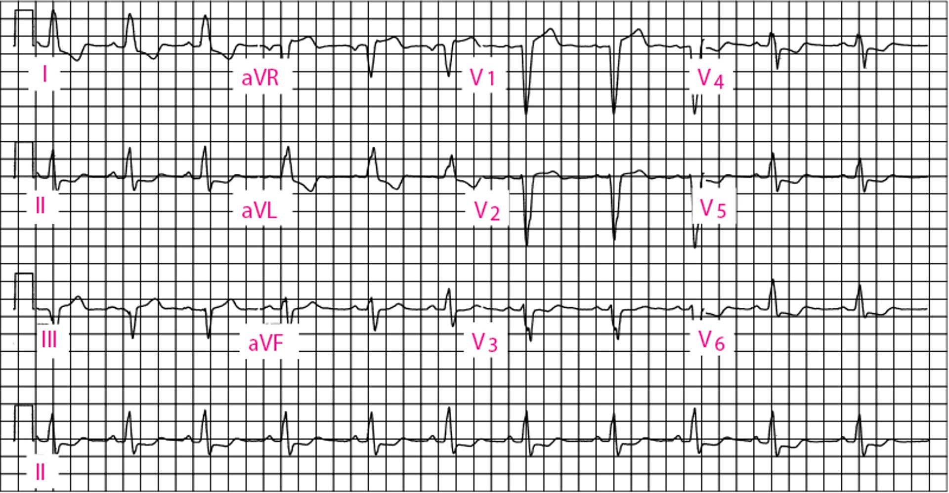 Blocco di branca sinistra