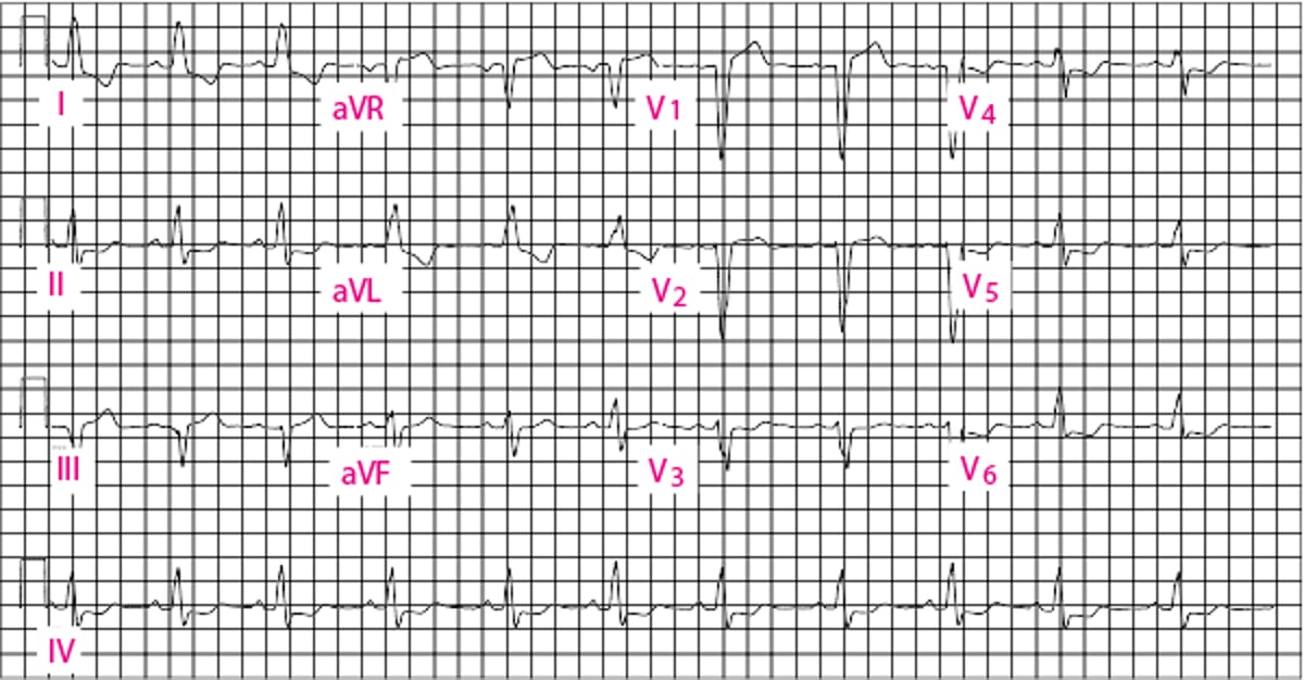 Bloqueio de ramo esquerdo