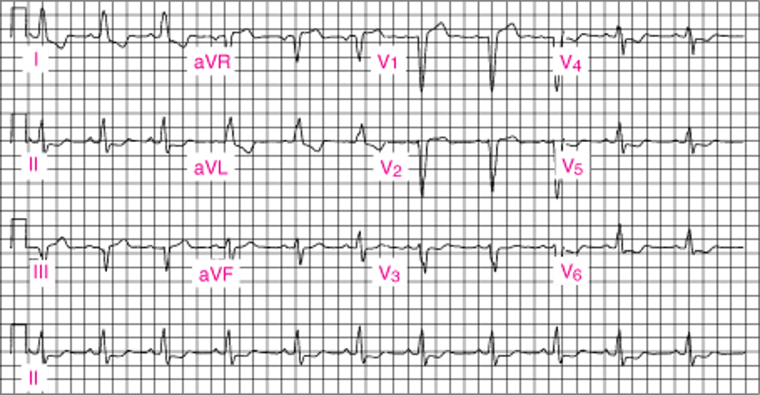 Блокада левой ножки пучка Гиса
