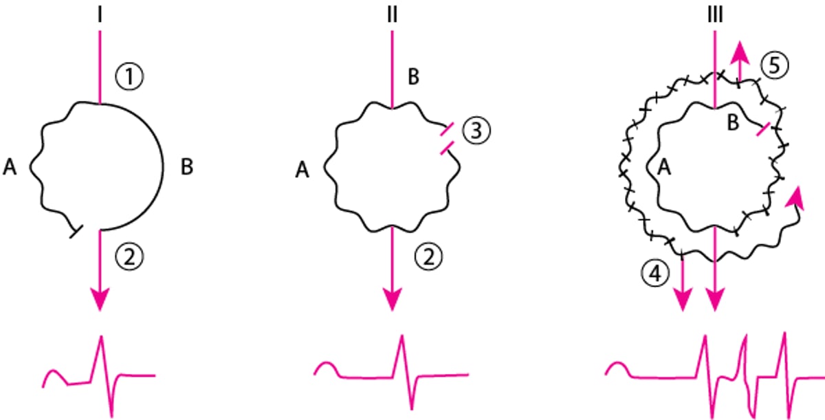 Mechanism of Typical Reentry